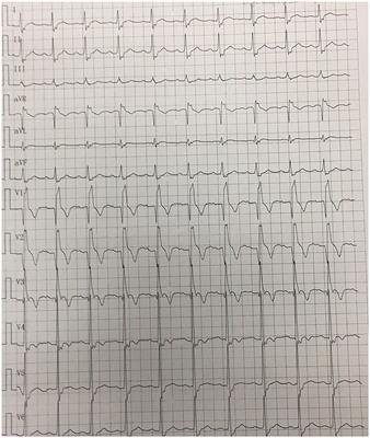 Case Report: A Case of Unusual Combination of Hypothyroidism, Myocardial Bridging, and Myocardial Infarction-Induced Left Ventricular Aneurysm